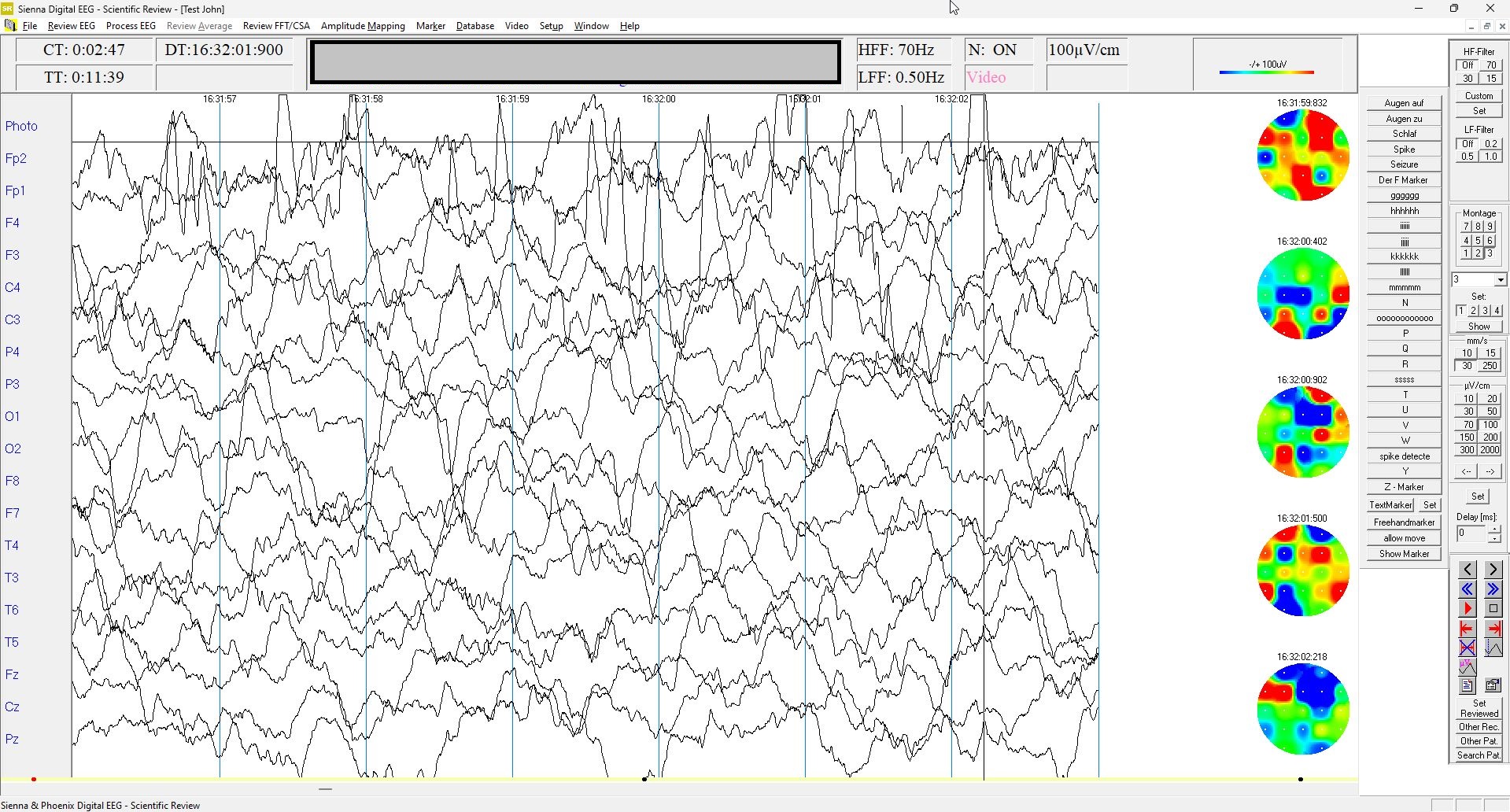 Digital Video EEG System